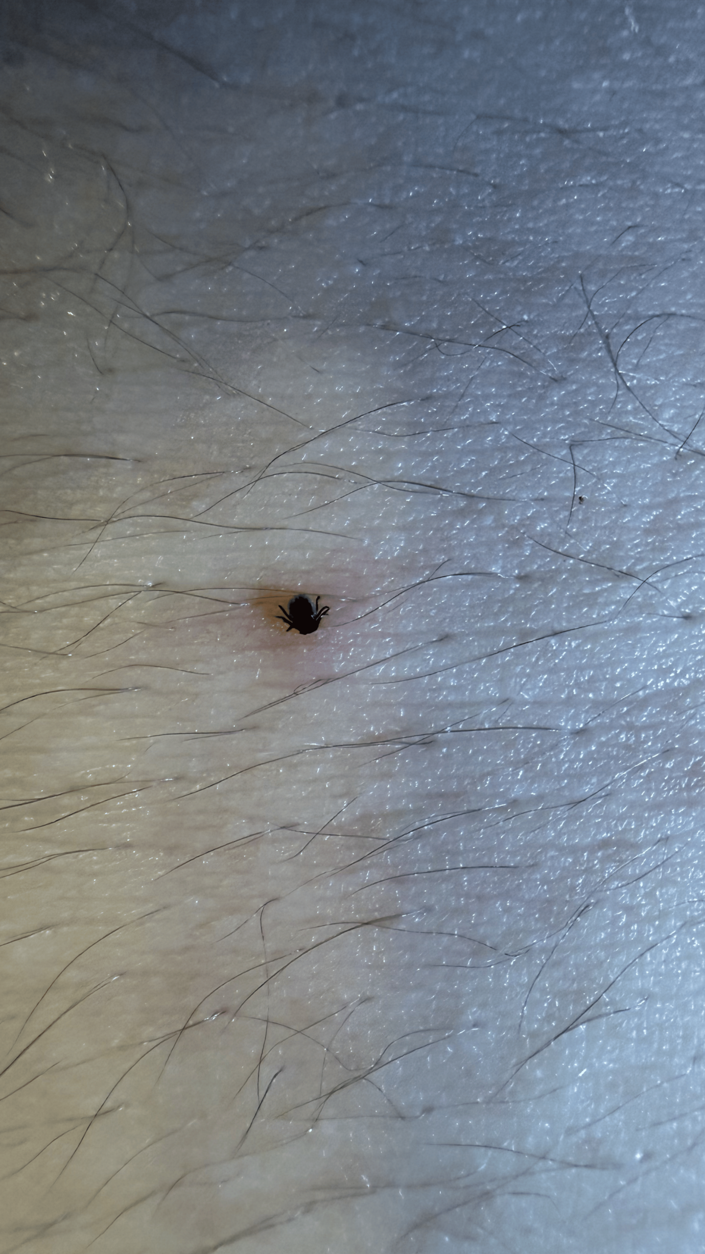 A tick attached and feeding in skin
